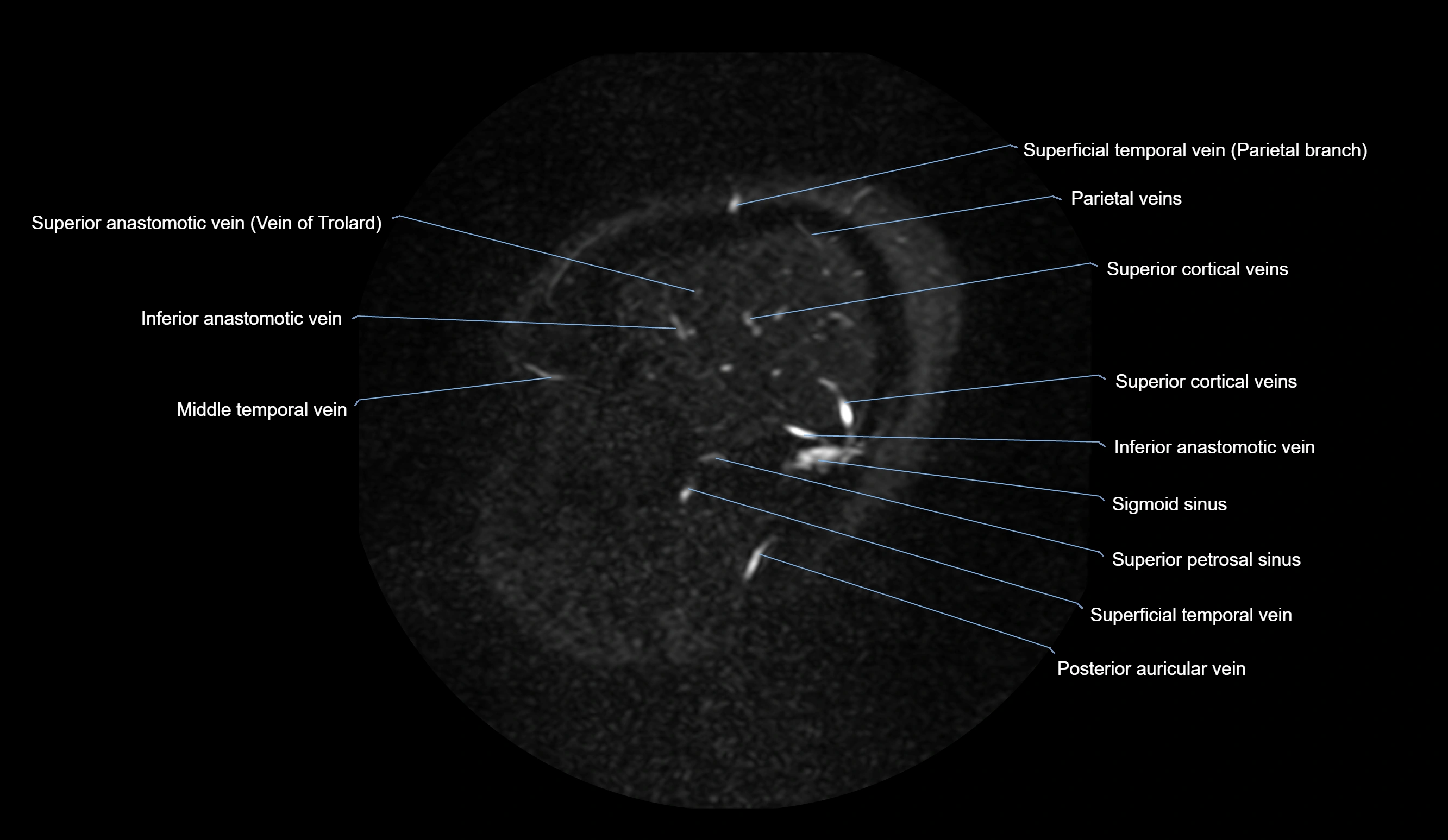 MRV brain sagittal anatomy 3T MRI images -img-01015-00014.webp